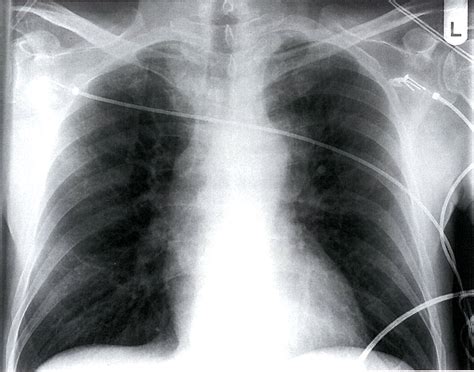 Thoracic Aortic Aneurysm Xray