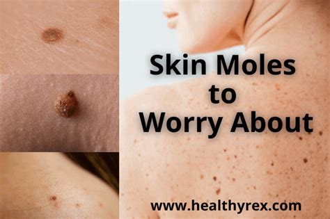 Skin Moles to Worry About – A Complete Guide With Skin Moles Pictures