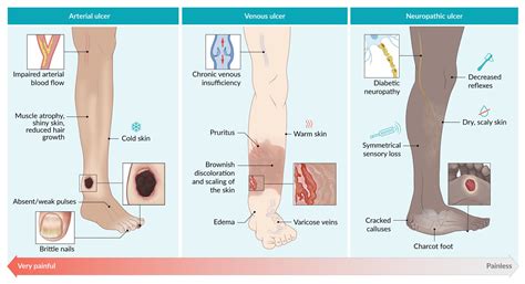 Arterial Insufficiency Ulcers – Adult And Pediatric, 54% OFF