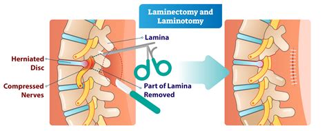 laminectomy laminotomy | AllSpine