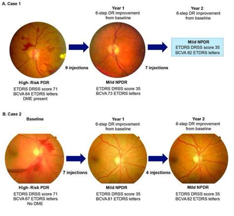 Mild Diabetic Retinopathy