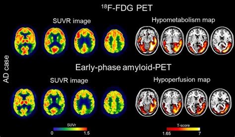 Dual-phase protocol: a two-for-one deal for brain imaging | SOMEONE ...