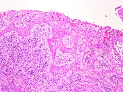 Radicular Cyst Histology