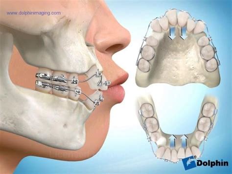 how braces work after extraction - Renay Grubbs