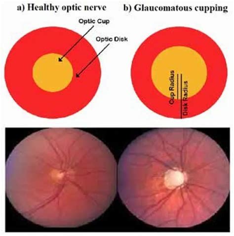 Optic Nerve Cupping - Nova Eyecare