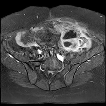 Tubo-ovarian abscess following cesarian section | Radiology Case ...