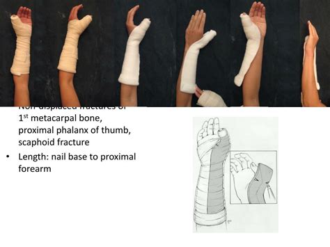 Proximal radial head fracture splint - keryrobo