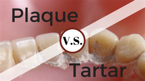 Plaque vs. Tartar: What's The Difference? | Britt Dental Center ...