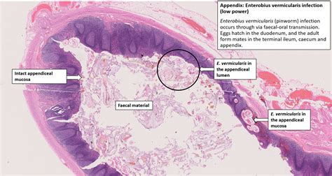 Appendix – Acute Appendicitis – NUS Pathweb :: NUS Pathweb