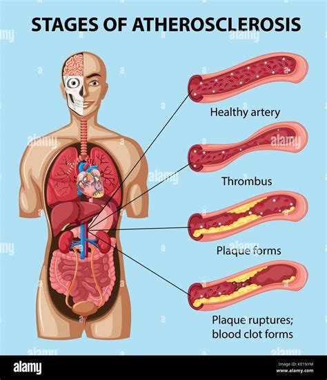 Diagram showing stages of atherosclerosis in human illustration Stock ...