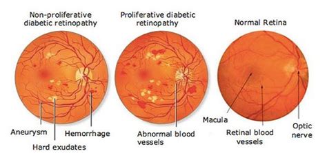 Diabetic Retinopathy | Eye and Retina Specialists