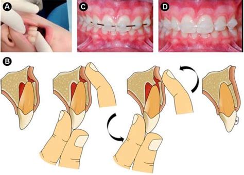 Tooth Luxation