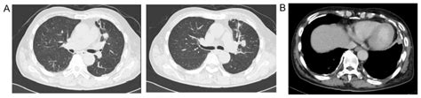 What Are The Causes Of Transudative Pleural Effusion