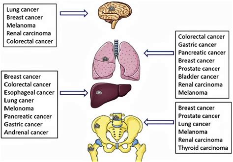 Cancer metastasis causes, symptoms and metastasis survival rate