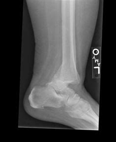 Bimalleolar ankle fracture surgery - enstat