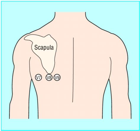 emDOCs.net – Emergency Medicine EducationECG Pointers: Posterior MI ...