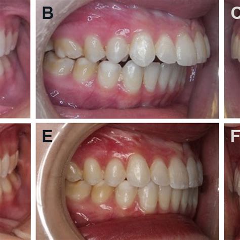 Case 2: Patient has a Class II malocclusion with an anterior open bite ...