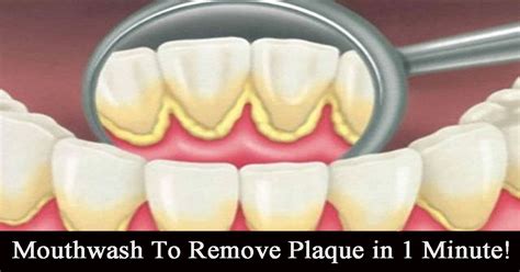 This Mouthwash Removes Plaque From Teeth In 2 Minutes - Holistic Living ...