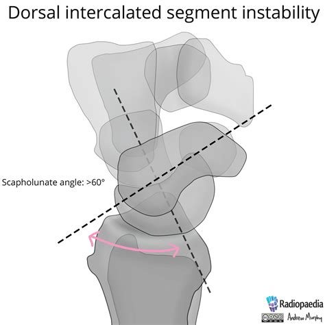 File:Normal wrist alignment, dorsal and volar intercalated segmental ...