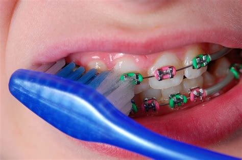 How To Brush Your Teeth With Braces : What Happens If You Have Braces ...