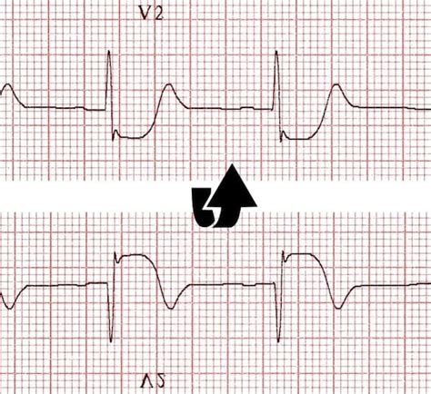 Posterior Myocardial Infarction • LITFL • ECG Library Diagnosis