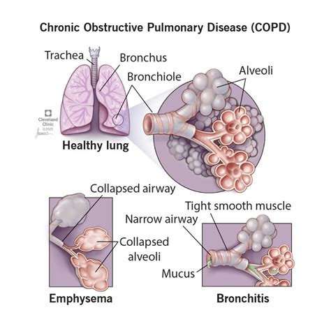 Does CBD Gummies help copd - CBD Guide