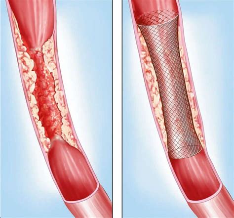 Stenting - Bel Air, MD & Towson, MD: Vascular Surgery Associates, LLC