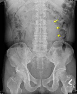 Abdominal aorta aneurysm – Radiology Cases