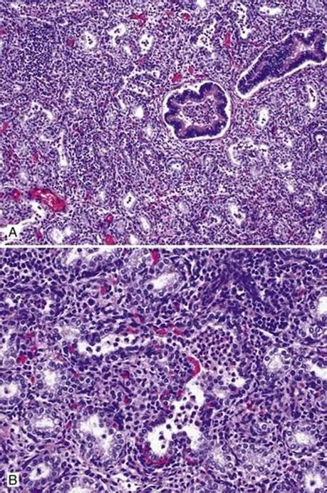 Lobar Pneumonia Histology