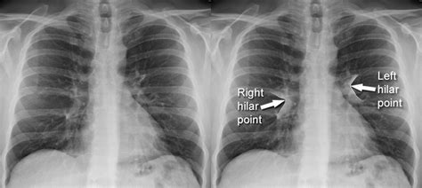 Hilum Chest X Ray