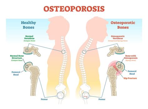 Osteoporosis Treatment: Best Natural Treatment with Diet, Injection ...