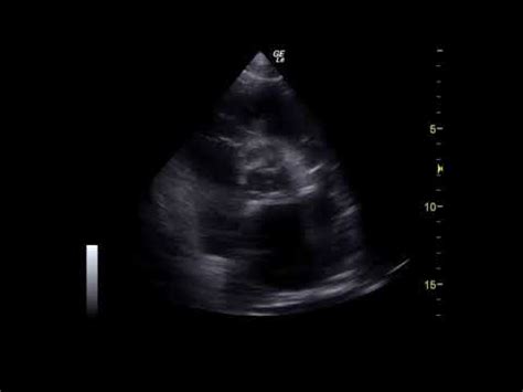 congestive heart failure echocardiography - YouTube