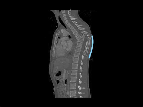 Thoracic spine fracture dislocation: Posterior open reduction and ...