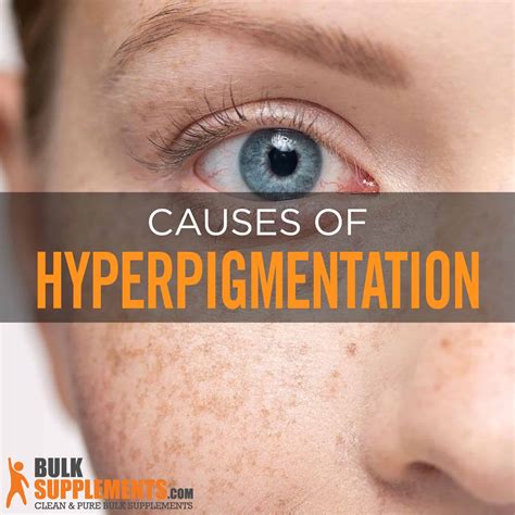 Hyperpigmentation: Symptoms, Causes & Treatment