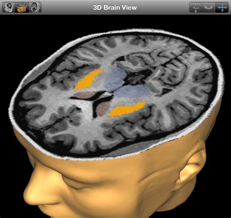 Brain Posts: MRI Biomarker for Parkinson's Disease Progression