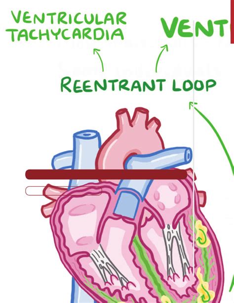 Ventricular fibrillation | Osmosis