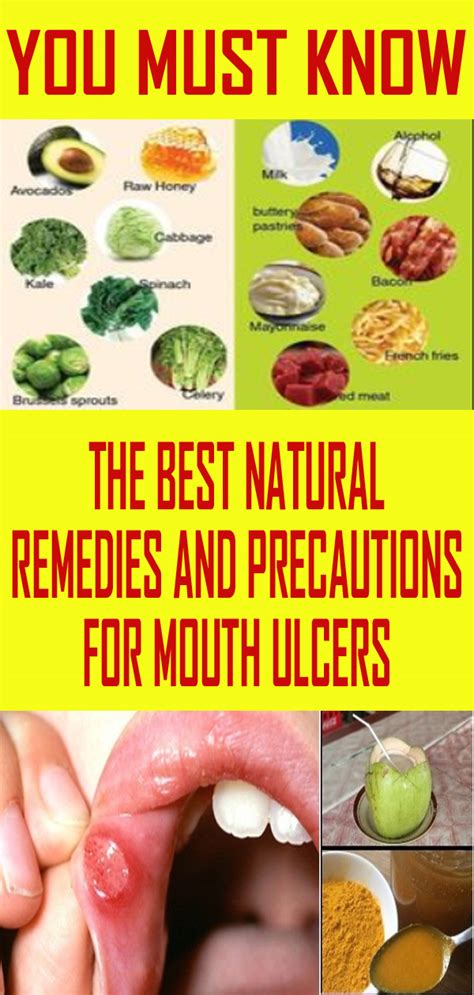 THE BEST NATURAL REMEDIES AND PRECAUTIONS FOR MOUTH ULCERS - exstremboard