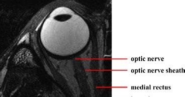 Radiology Anatomy Images : Optic Nerve MRI Anatomy