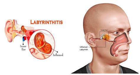 Labyrinthitis| causes, pathology, clinical picture, diagnosis, treatment