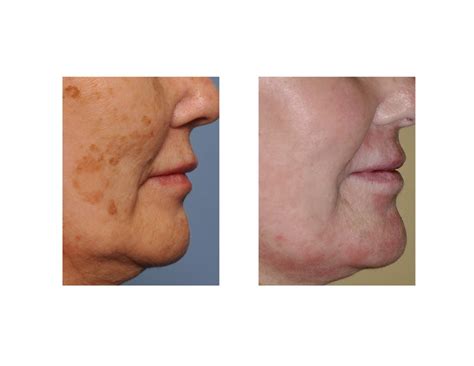 Case Study: Laser Resurfacing for Facial Brown Spots - Explore Plastic ...