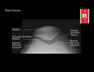 Normal Knee Xray - Knee Joint Anatomy - Knee Replacement Surgery