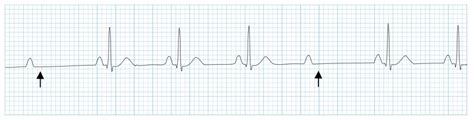 Atrioventricular (AV) Heart Block - Cardiovascular - Medbullets Step 1