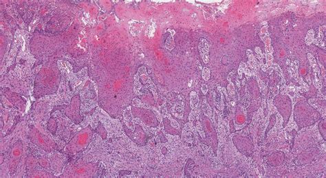 Squamous cell carcinoma of the oral cavity | MyPathologyReport.ca