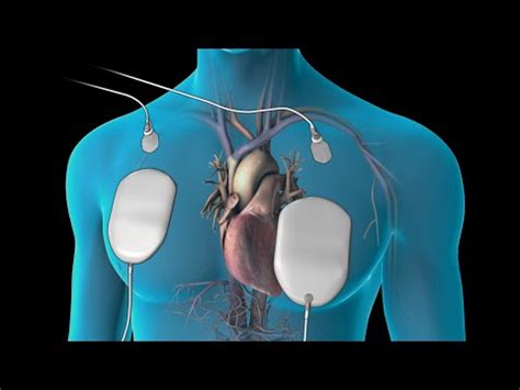 Cardioversion (for Atrial Fibrillation) | Doovi