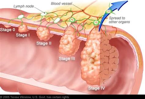 Colon Cancer | Leaders in Pharmaceutical Business Intelligence (LPBI) Group