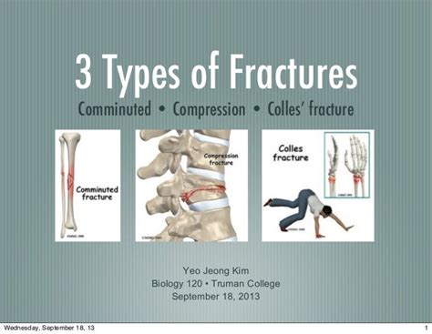 Types Of Compression Fractures - Design Talk