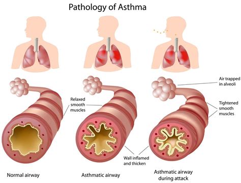 Asthma - Pediatric Pulmonologists