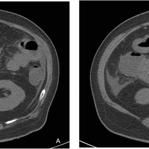 a, b One patient with gastric cancer. a Enlargement of mesenteric lymph ...