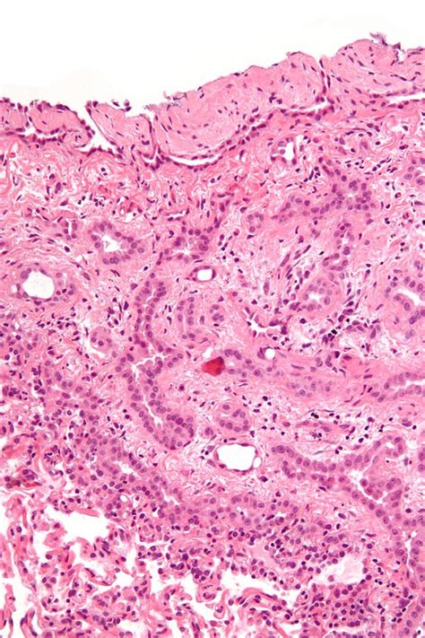 Malignant mesothelioma - Libre Pathology