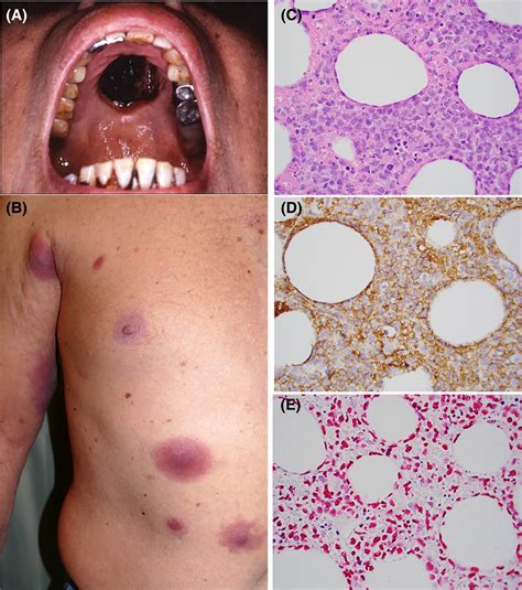 T Cell Lymphoma Skin Cancer